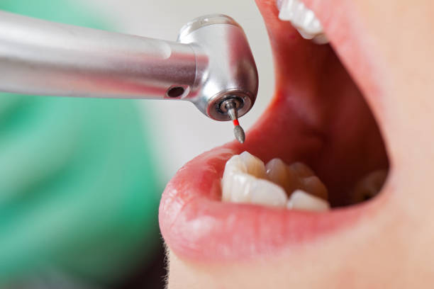 Best Emergency Tooth Extraction in Coral Terrace, FL